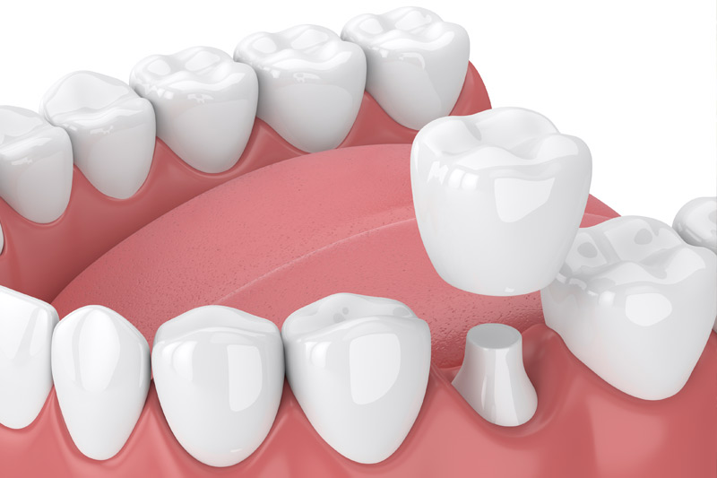 Dental Crowns in Lake Forest