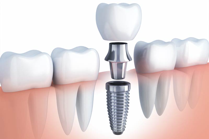 Implants Dentist in Lake Forest
