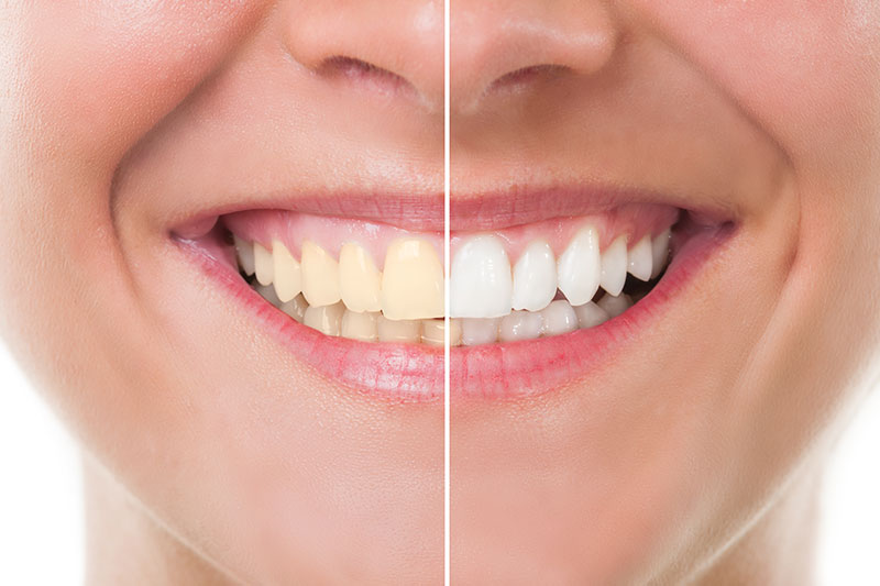 Teeth Whitening in Lake Forest