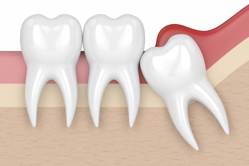 Wisdom Tooth Removal in Lake Forest